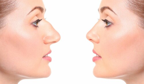 Liquid-Rhinoplasty-London-img1.jpg